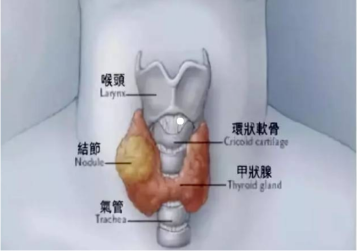 病例追踪：金草消毒颗粒对自身免疫性甲状腺疾病患者的治疗有疗效！ 最新动态 第1张