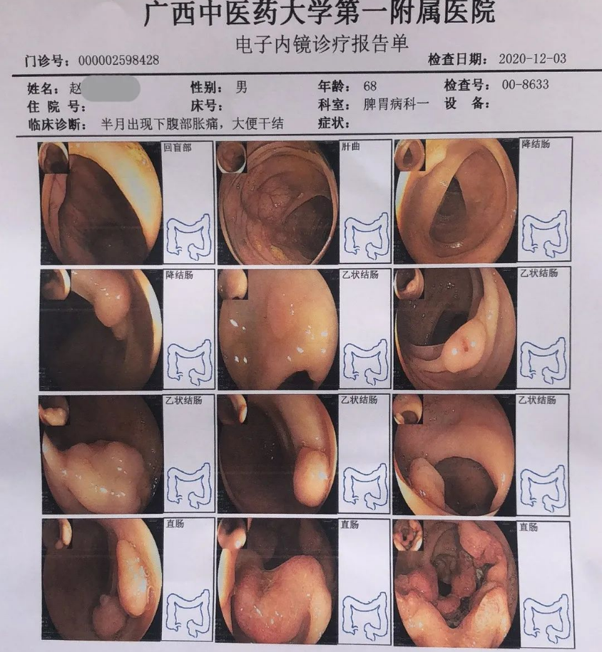 案例传真：金草消毒颗粒又挽救1例肠癌患者 最新动态 第9张